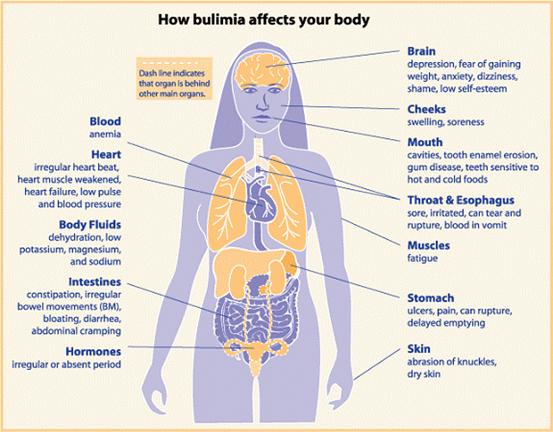 bulimia before and after face